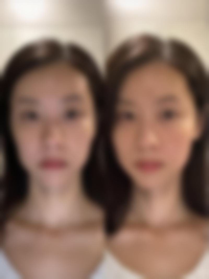 疤痕疙瘩能长平吗：大面积疤痕疙瘩的治疗挑战与希望