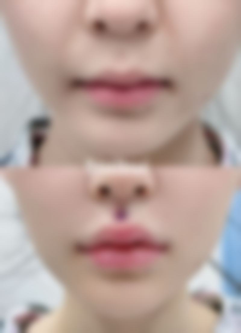 疤痕疙瘩能长平吗：多年顽固疤痕的改善希望