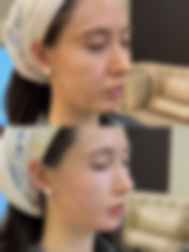 宝尼达隆鼻快速修复到更好状态的方法——医生不会告诉你的 7 个秘诀