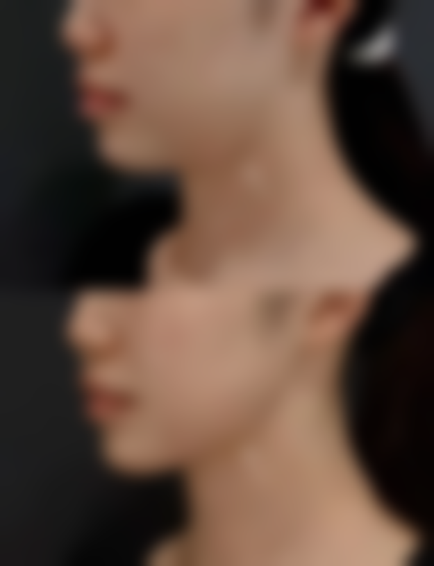 影响宝尼达隆鼻修复更好状态时间的因素——你的修复速度由这些决定