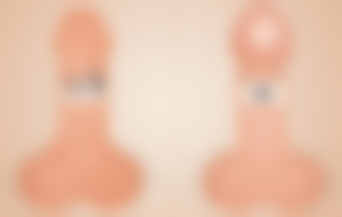 20年前埋线双眼皮需要拆线吗？拆线必要性及注意事项全解析