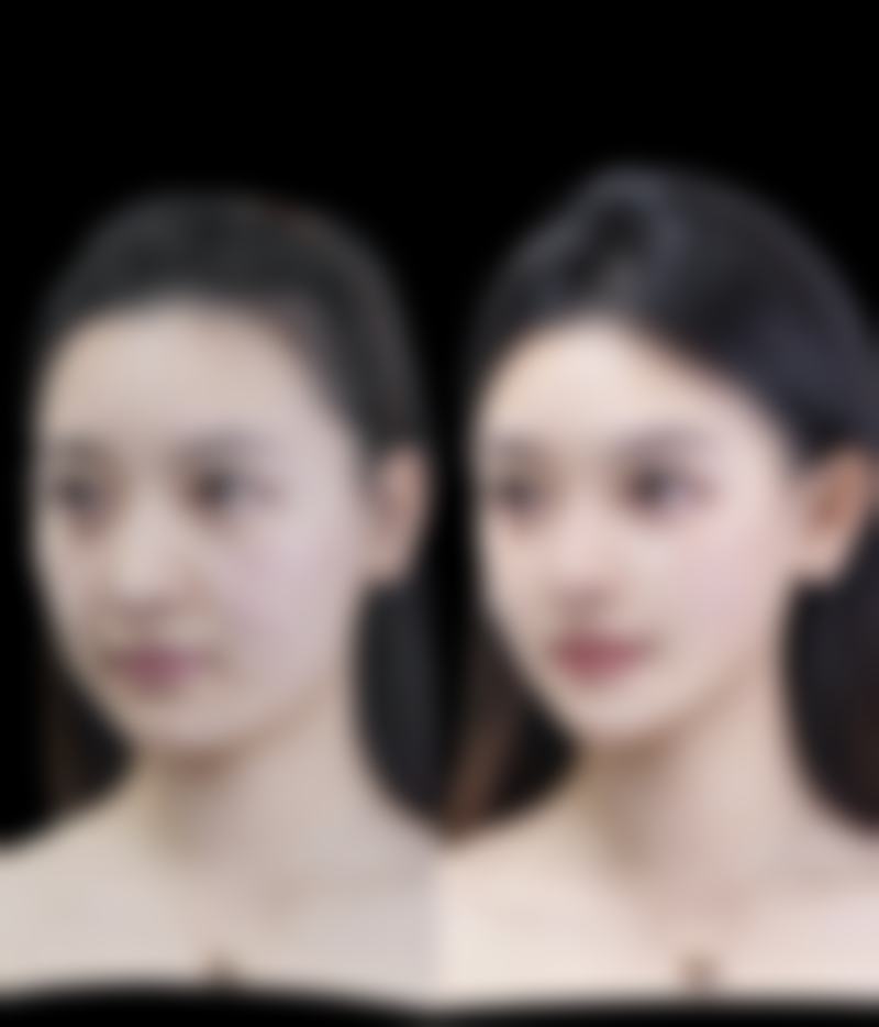 眼睛热敷去不同类型眼袋的成效大对比——看看你的眼袋适合吗