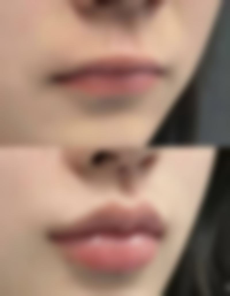 如何解决疤痕疙瘩，胸部脸部术后疤痕全攻略，儿童大面积陈旧性疤痕也能消