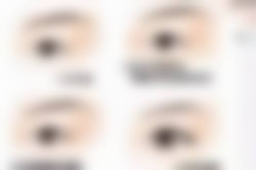 甲亢手术疤痕怎样恢复的好，腔镜微创+硅酮凝胶，7天淡化疤痕重拾自信