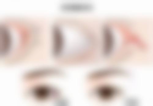 点痣后疤痕有点增生怎么办：医用硅酮祛疤膏——你的第一道防线