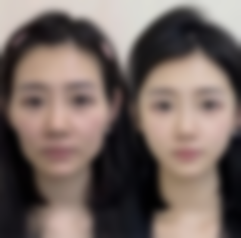 点痣后疤痕有点增生怎么办：特殊情况的应对策略