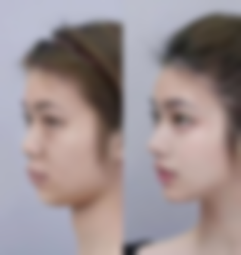 半肋骨隆鼻子恒久成效的维持时间与年龄选择