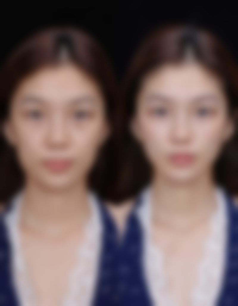 甲亢手术疤痕怎样修复的好之医院选择