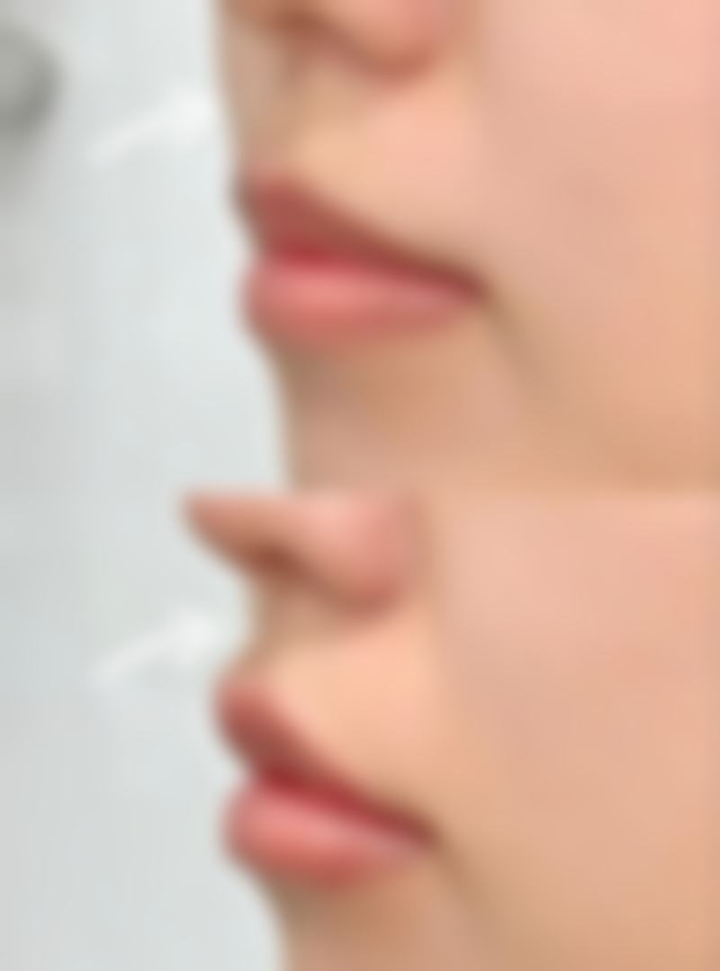 半肋骨隆鼻子恒久保持与术后护理的关系