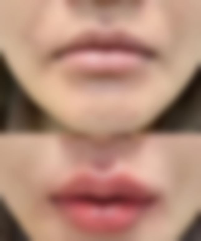 甲亢手术疤痕怎样修复的好之时间规律