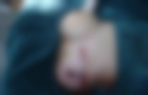 老年人割眼袋的方法选择