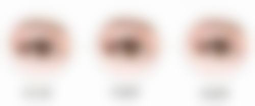 痤疮疤痕：手贱的代价能否挽回