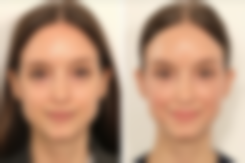 三点定位双眼皮对眼睛有伤害吗