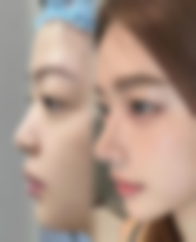 老年人割眼袋的手术风险与规避