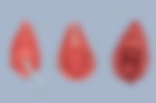 六、广州中山一院分析做完双眼皮一个月哭了会影响对称成效吗