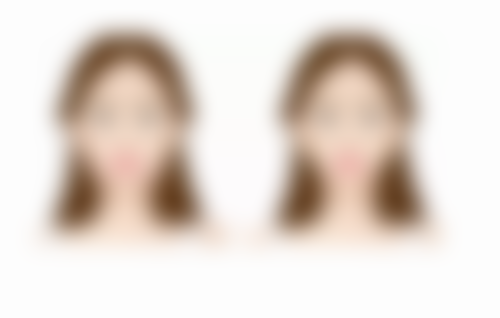 做眼袋手术大概需要多久修复：影响修复期的关键因素