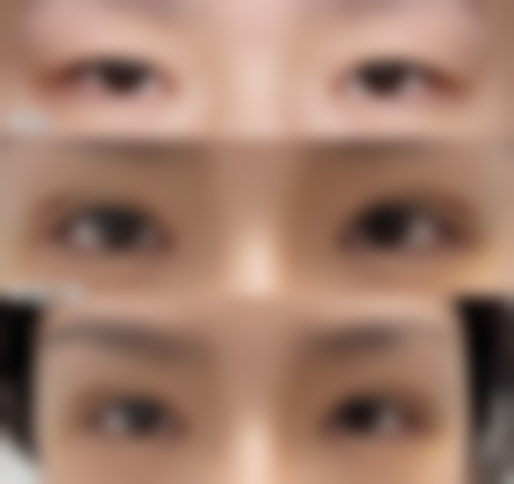 五、中日友好医院解读做完双眼皮一个月哭了会影响眼部形态成效吗