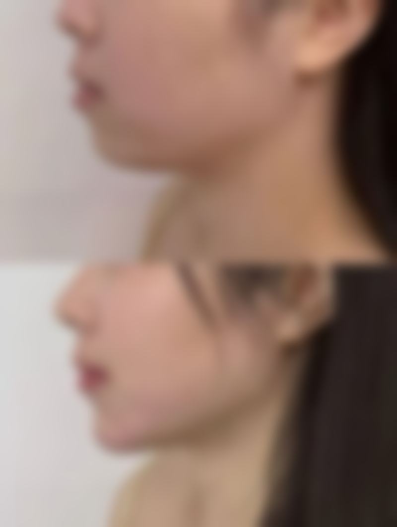 做眼袋手术大概需要多久修复：术后修复时间表