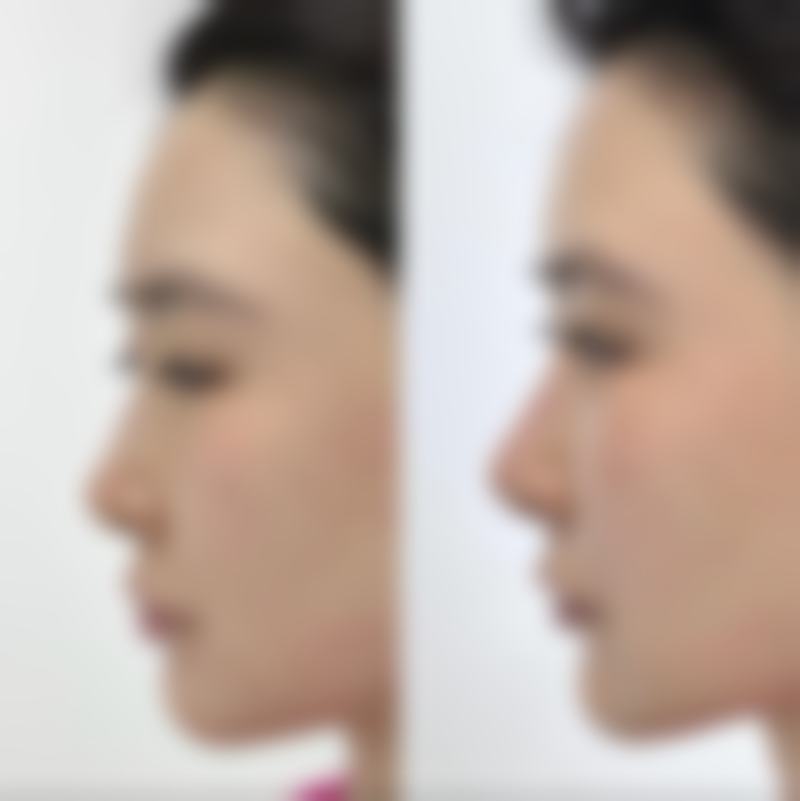 疤痕疙瘩怎么去除呢——激光治疗：无创美容级解决方案