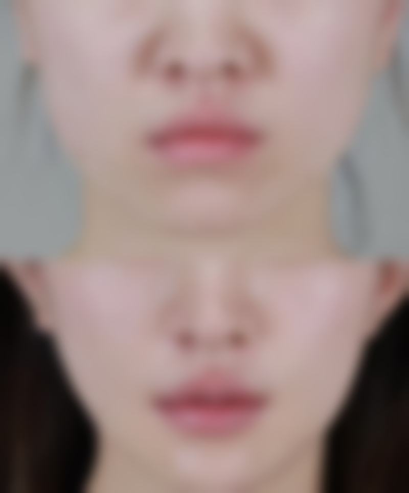 去去眼袋用什么方法最佳，激光微创VS中医按摩，三甲医院推荐这5种方案