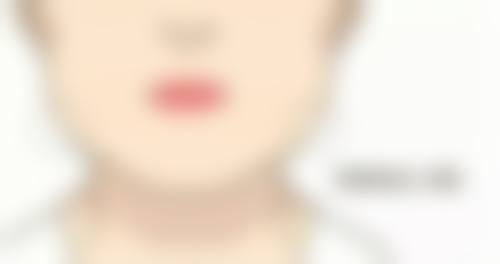 胡国强医生做手术价格