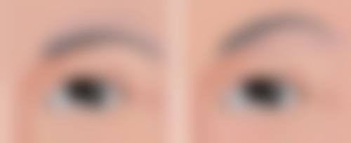 什么办法可以淡化缝针疤痕，激光药物双管齐下，快速修复陈旧性疤痕不留痕