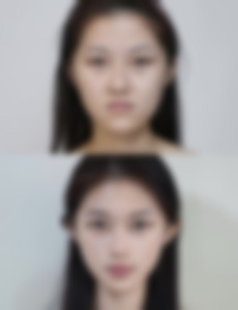 走出误区，科学治疤：正确认识瘢痕疙瘩