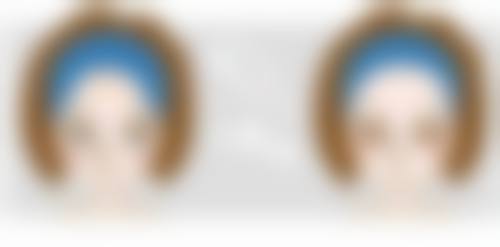 切除眼袋对泪沟的影响：可能比你想象的复杂