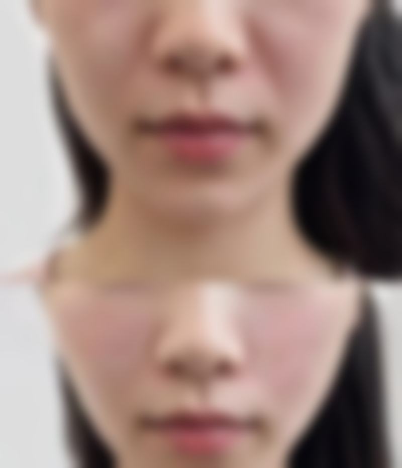 脂肪填充才是解决泪沟的关键王牌