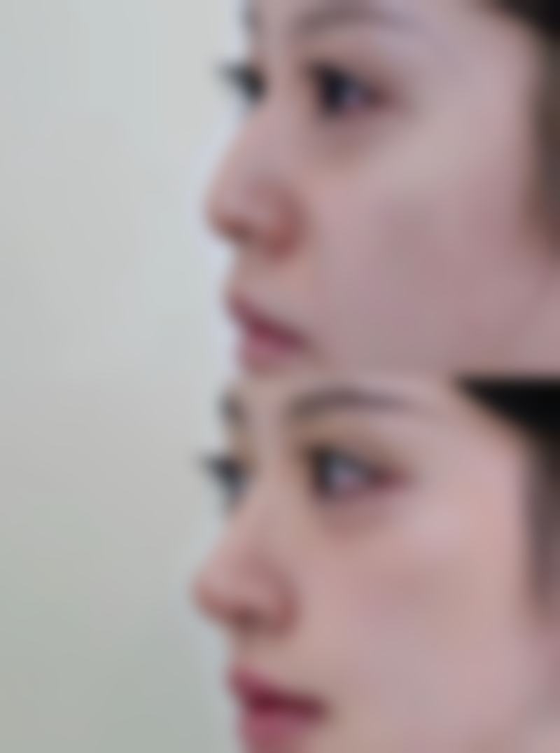 切除眼袋后泪沟会消失吗？因人而异的美容成效