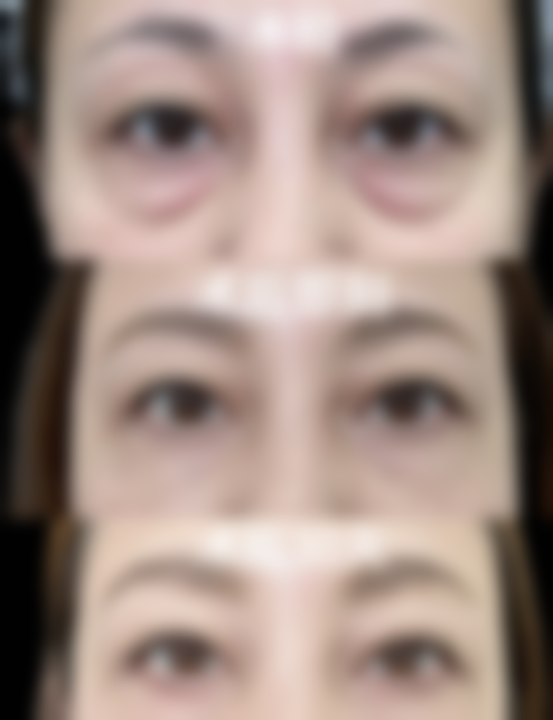 除皱针打一次能管多久：安心提醒与成效较大化