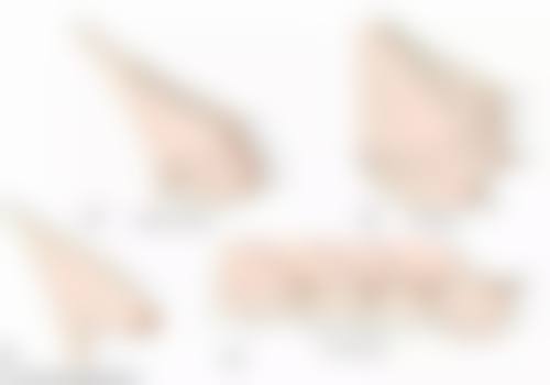 自体脂肪和假体隆胸哪个比较安心:存活率与稳定性的考量