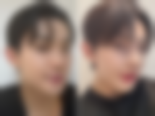 额头摔伤缝针的疤痕怎么去——8cm疤痕消失的成功实例