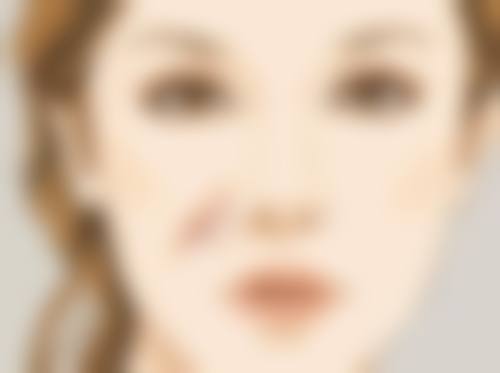 七毫米的双眼皮会成内双吗——真实实例见证奇迹