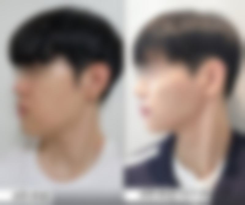 红霉素软膏涂陈旧性疤痕处可行吗？成效微乎其微