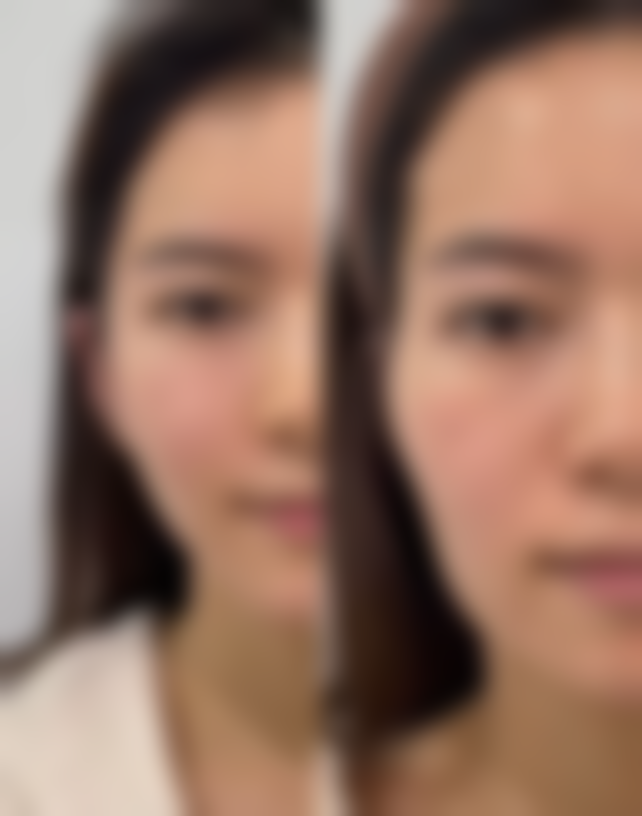 七毫米的双眼皮会成内双吗——消失原因深度剖析