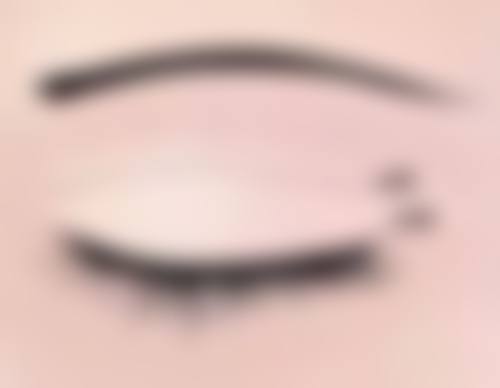 遗传性眼袋黑眼圈可以自愈吗：基因注定难自愈