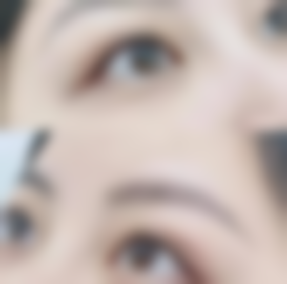 眼袋黑眼圈可以自愈吗？熬夜型能消退，遗传性需医美拯救！