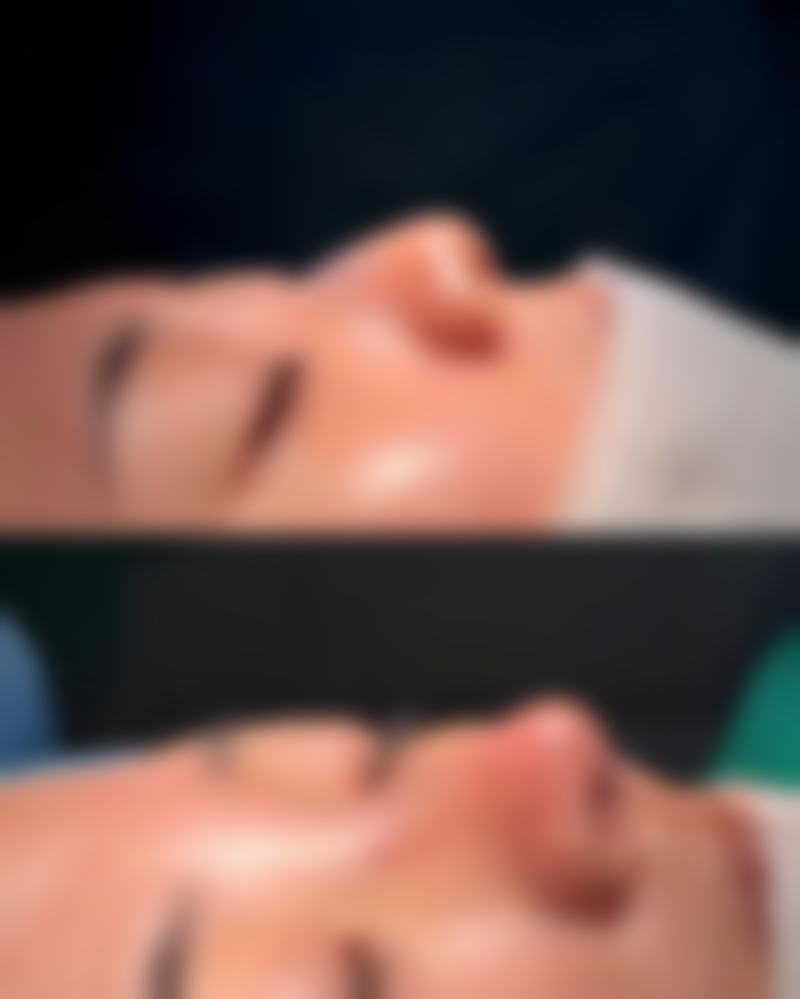 药水点痣会疤痕增生吗？揭秘增生原因+3种有效预防方法