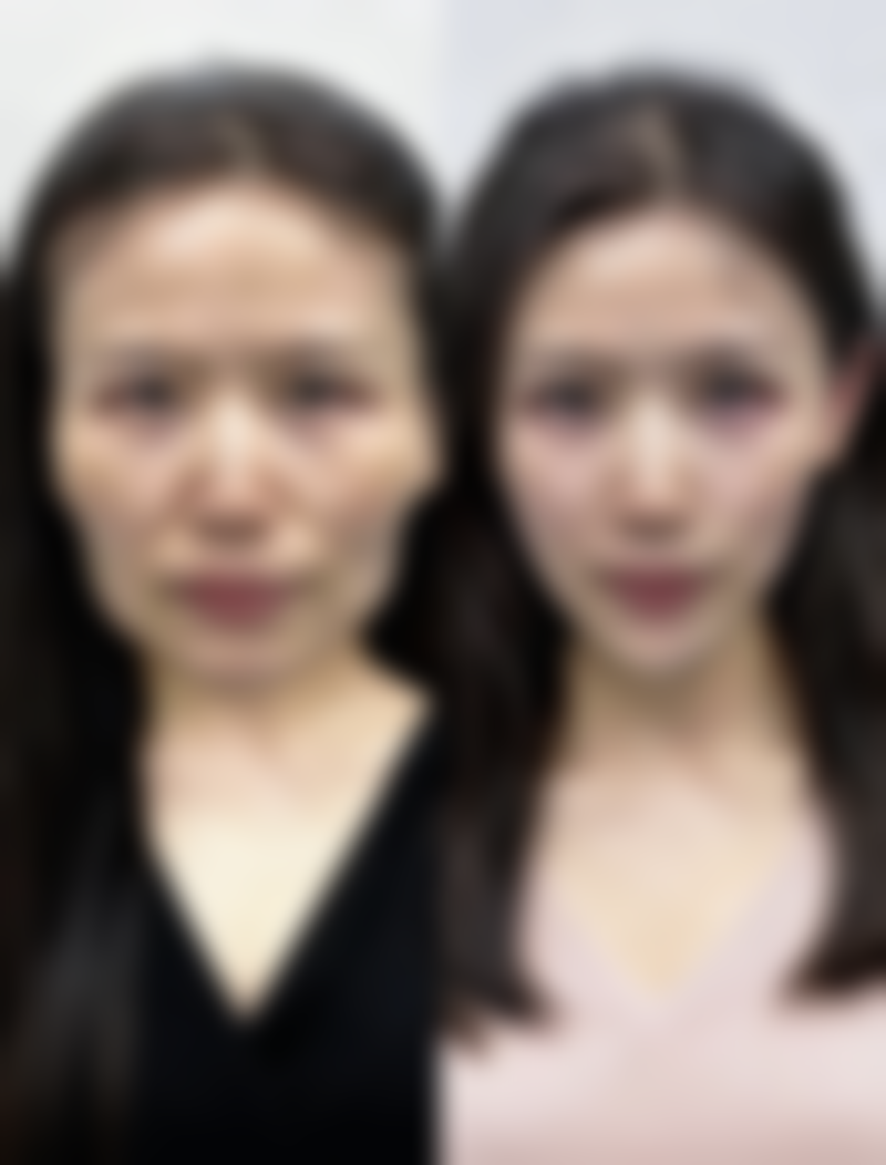 眼睛的眼袋怎么解决之饮食调理妙方