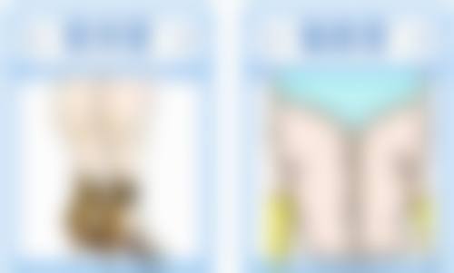 切开双眼皮多长时间修复——影响修复时间的三大关键因素