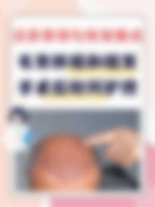 如何选择适合自己的植发方案