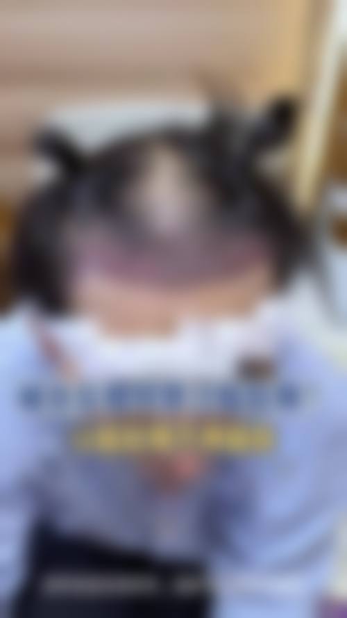 20000元微针植发效果如何？曙光植发专科技术与优质服务为您解答 