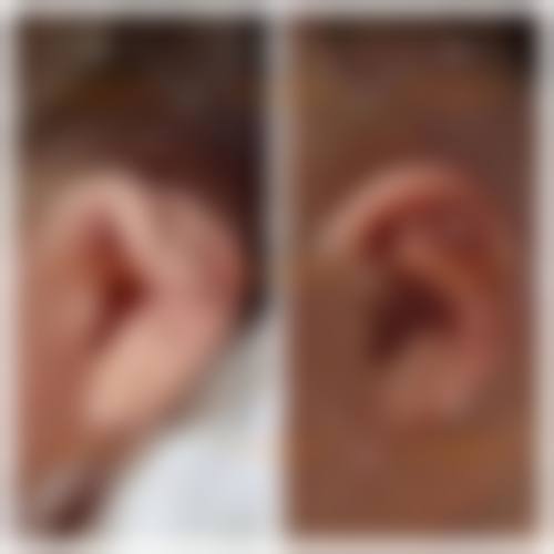 山东省刘晨涛在青岛瑧妍美医疗美容医院做隆胸项目的费用及评价