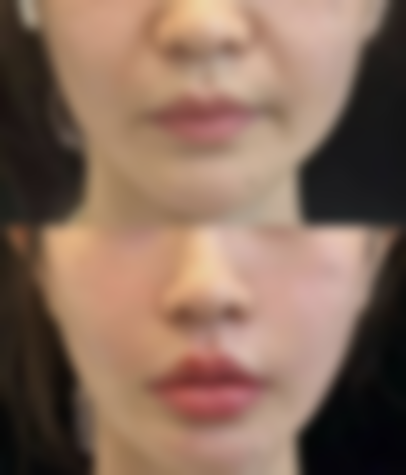 切开双眼皮多长时间修复——年轻人修复快？老年人修复慢？