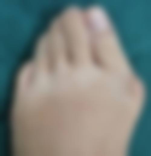 隆鼻碰到了会怎么样——轻微碰撞：鼻子的“小抗议”