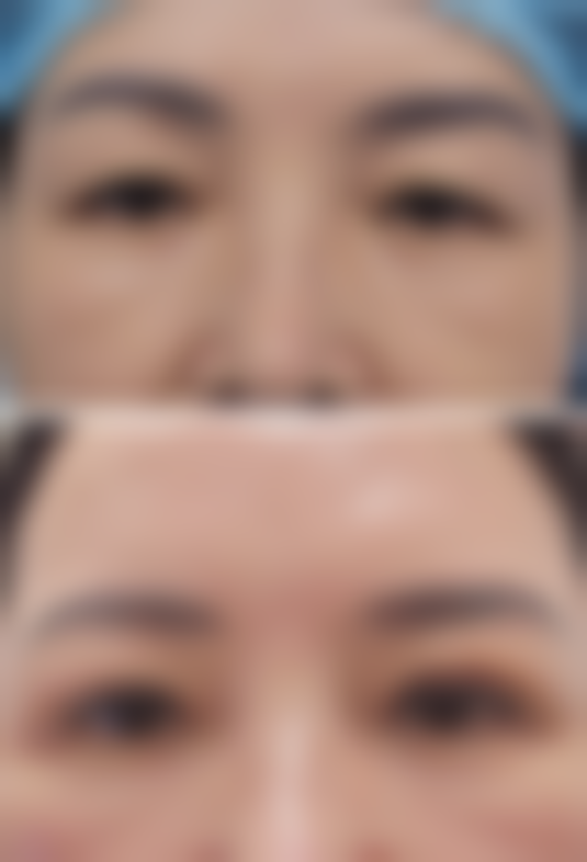 何种眼袋适合冰敷