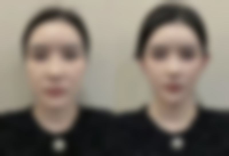 注射隆胸哪种材料好之胶原蛋白：自然派的温柔使者