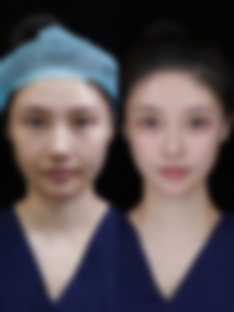 腿部抽脂有危害吗？揭秘凹凸不平、脂肪栓塞等风险及预防方法