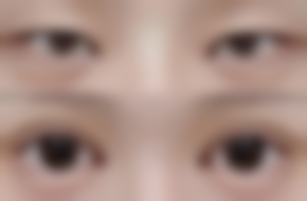 腿部抽脂的医院考量与皮肤松弛问题